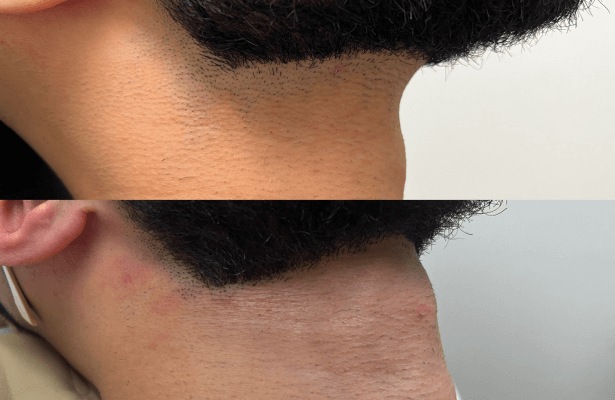 Laser Hair Removal For Men before and after Calgary